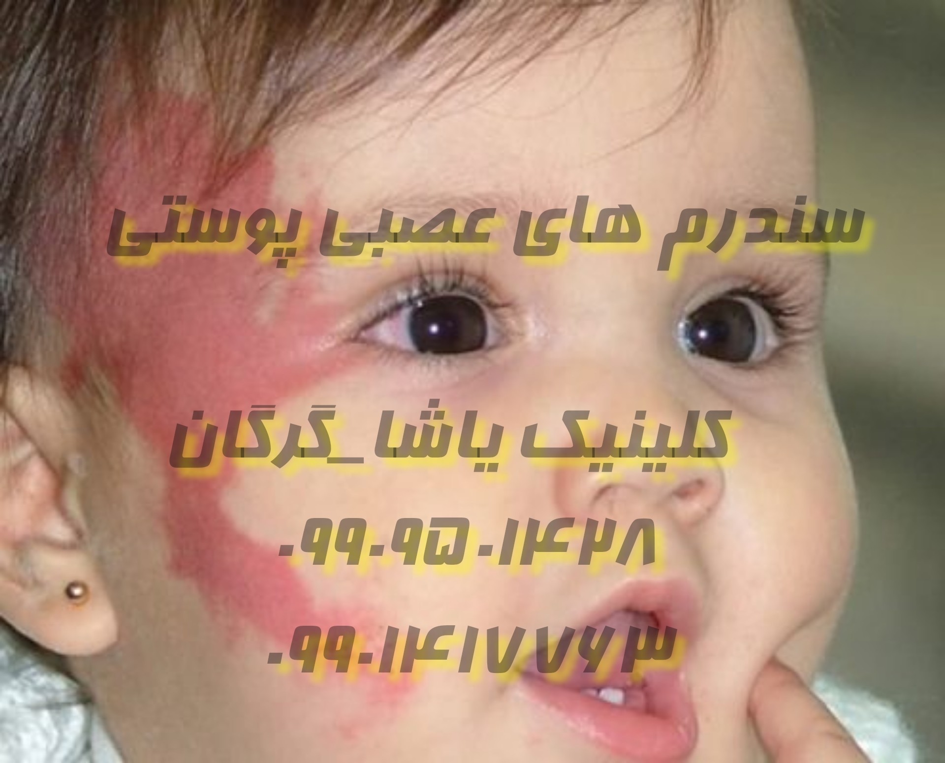 CTD2902021221349 سندرم عصبی جلدی ـ معرفی پزشکان ۰۹۹۰۹۵۰۱۴۲۸