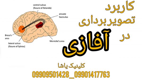 درمان آفازی در گرگان 09909501428 تصویر مغز