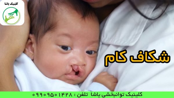 گفتاردرمانی در گرگان درمان شکاف کام
