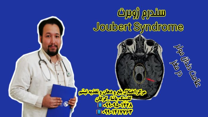 سندرم ژوبرت و توانبخشی در گرگان _09909501428 حنیف امانیان