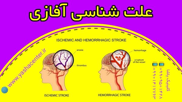 اتیولوژی آفازی و درمان آن 09909501428 حنیف امانیان