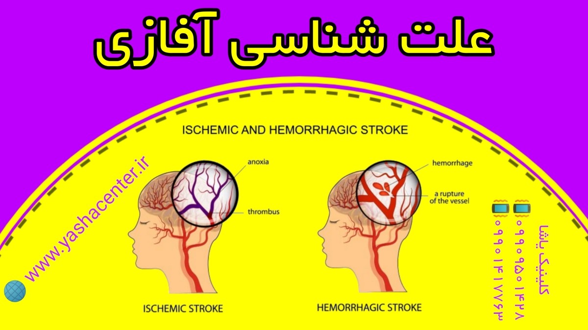 اتیولوژی آفازی و درمان آن 09909501428 حنیف امانیان