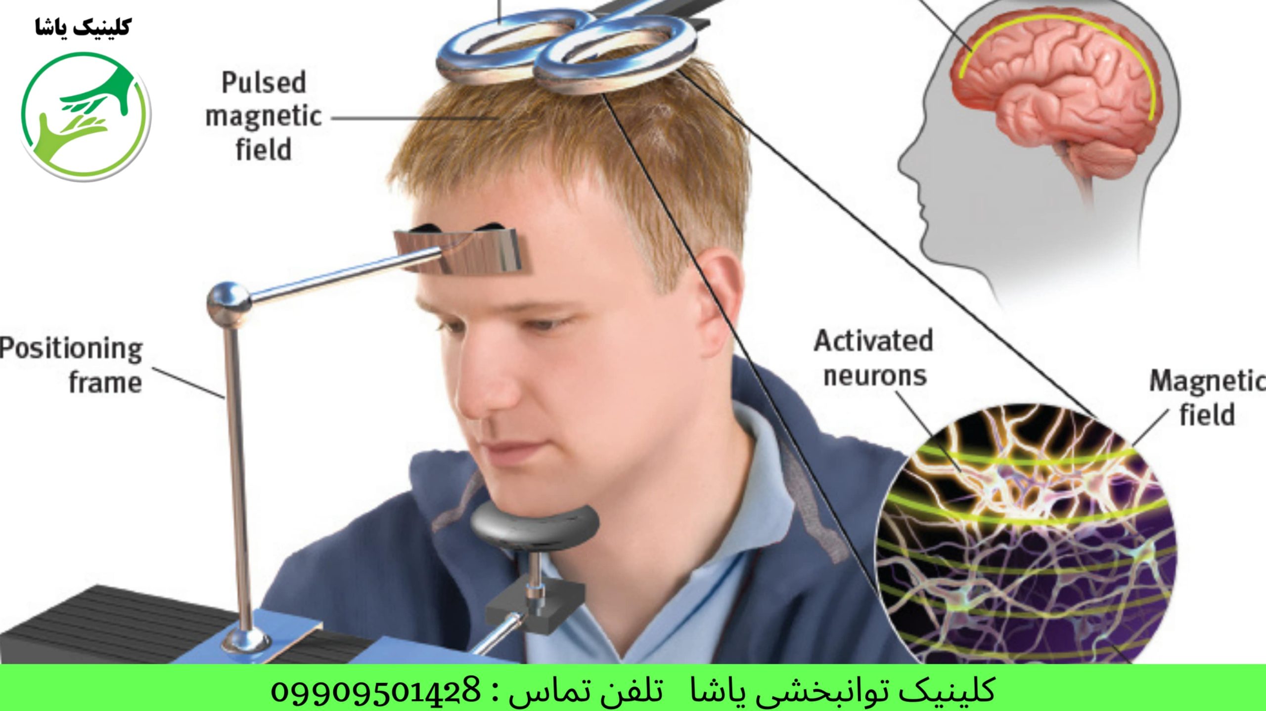 گفتاردرمانی در گرگان کاردرمانی در گرگانروانشاسی در گرگان درمان سکته مغزی در گرگان کلینیک توانبخشی یاشا 09909501428
